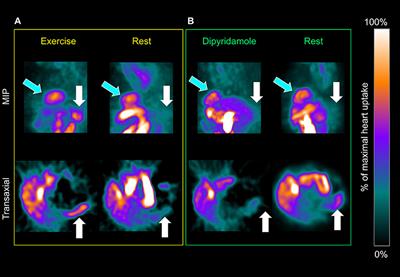 Spleen Perfusion as an Index of Gender Impact on Sympathetic Nervous System Response to Exercise